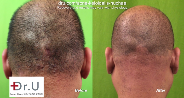 Before and after laser head bump treatment. The patient is satisfied with his results from Dr.U's laser head bump treatment. The After picture shows the bumps on back of the head lessened dramatically. Before and after laser head bump treatment. The patient is satisfied with his results from Dr.U's laser head bump treatment. The After picture shows the bumps on back of the head lessened dramatically.