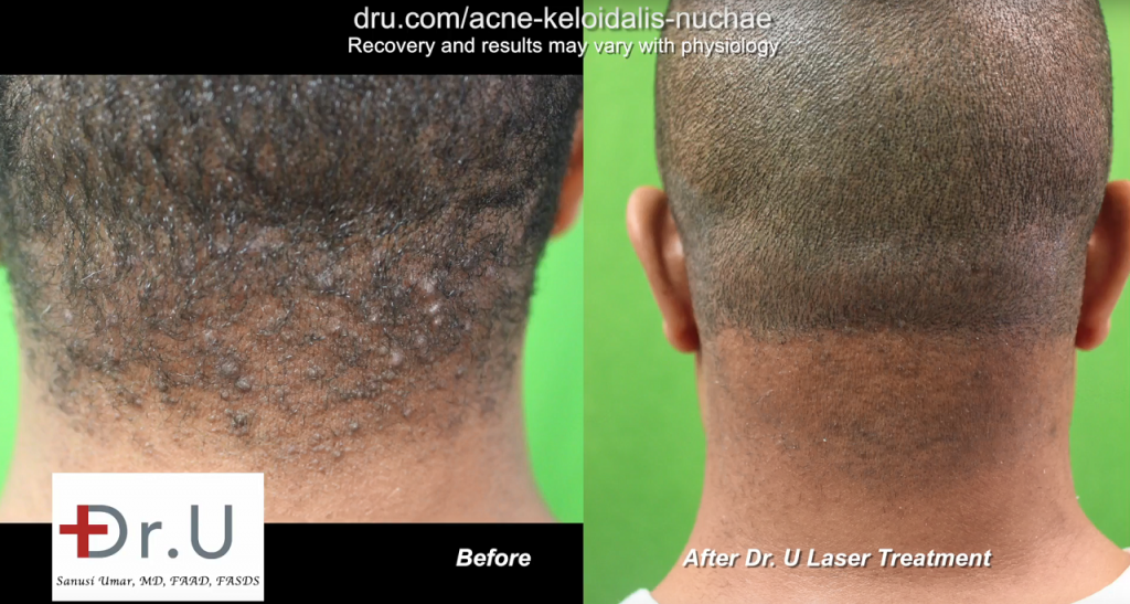 After a laser head bump treatment with Dr. U in Los Angeles, this patient reported the complete disappearance of the irritating "barber's rash" on the back of the head. After a laser head bump treatment with Dr. U in Los Angeles, this patient reported the complete disappearance of the irritating "barber's rash" on the back of the head.