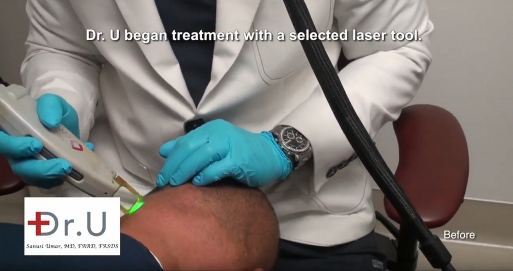 Dr. U performed laser bump removal for this patient's AKN. Over the course of several sessions, the patient saw the disappearance of these lumps and bumps.