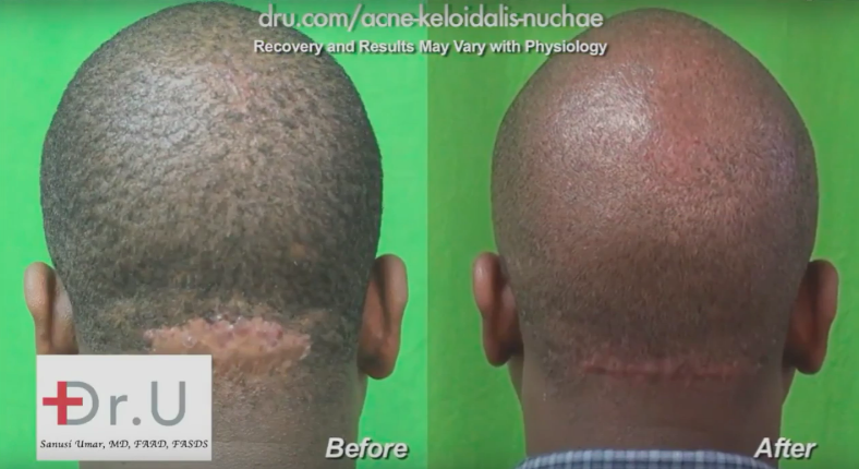 Before and after treating AKN, sometimes known as big bumps on back of head after haircut. Before and after treating AKN, sometimes known as big bumps on back of head after haircut.