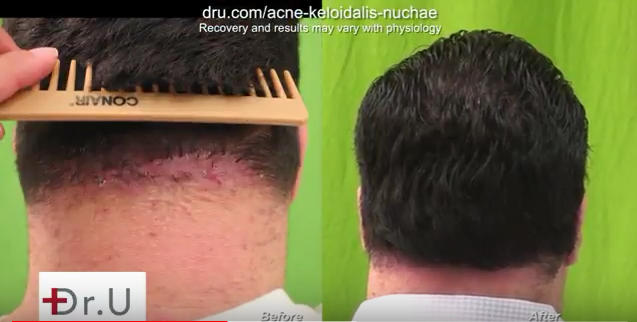 Another example of a patient who notices bumps on back of head after haircut and sought treatment from Dr. U in Los Angeles. Another example of a patient who notices bumps on back of head after haircut and sought treatment from Dr. U in Los Angeles.