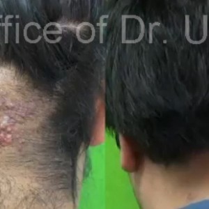 Read more about the article Acne Keloidalis Nuchae and Pseudofolliculitis Barbae