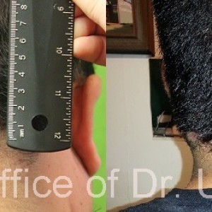 Read more about the article Folliculitis Keloidalis Nuchae- Results of AKN Surgery After Eight Weeks