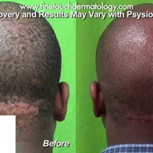 Read more about the article The Dermatology Behind Acne Keloidalis Nuchae