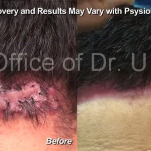 Read more about the article Patient with Advanced Acne Keloidalis Nuchae