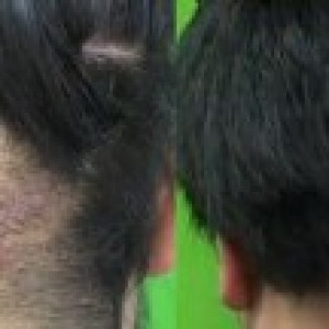 Read more about the article Patient With Early Stage Acne Keloidalis Nuchae