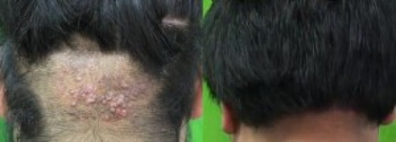 You are currently viewing Patient With Early Stage Acne Keloidalis Nuchae