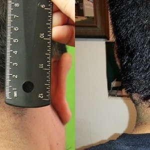 Read more about the article Acne Keloidalis Nuchae- One of the Causes of Cicatricial Alopecia